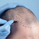 hair transplant 2