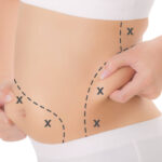 liposuction-2