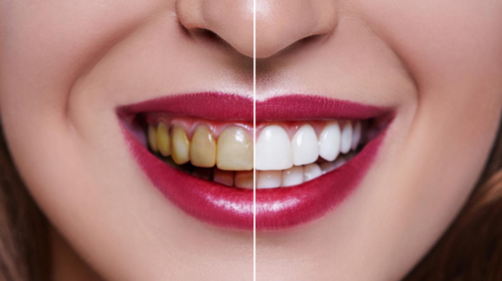 teeth whitning whıtnıng