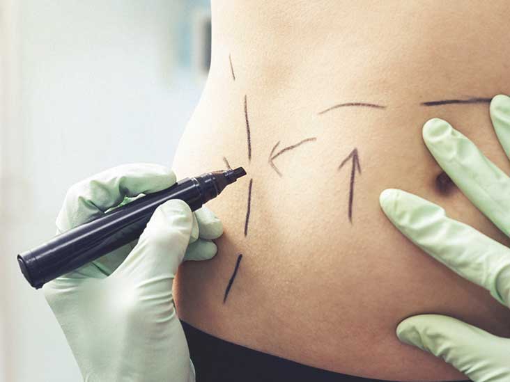 liposection liposection